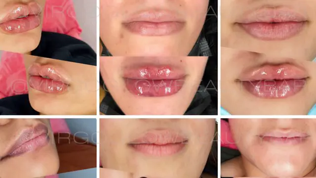 Advanced Lip Filler Course 