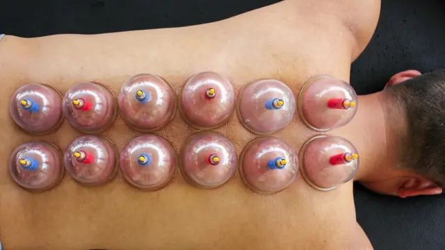 Cupping: Clinical Cupping Therapy