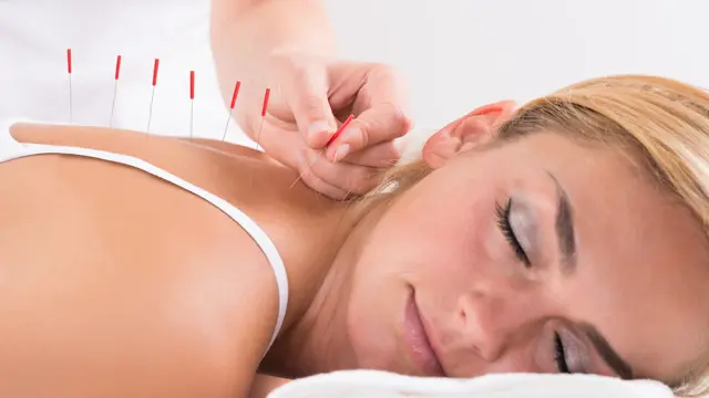 Acupuncture: Acupuncture Course - CPD Certified