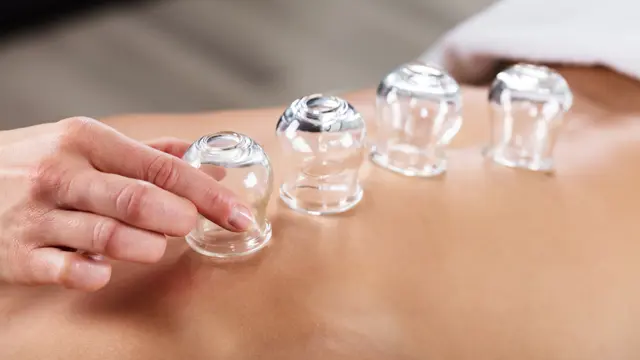 Cupping Therapy : Cupping Therapy