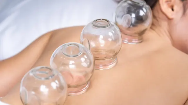 Cupping Therapy: Cupping Therapy Level 3