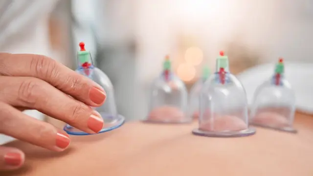 Clinical  Cupping: Clinical Cupping Therapy