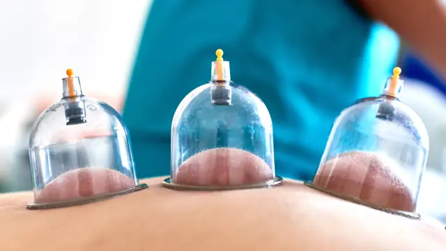Level 5 Cupping Therapy Training