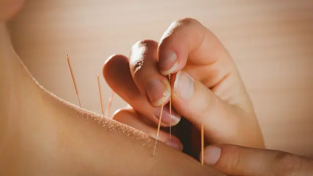 Acupuncture: Acupuncture Level 5
