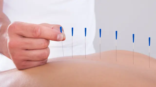 Acupuncture Level 5 Diploma