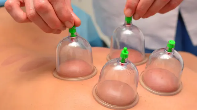 Cupping Therapy: Cupping Therapy