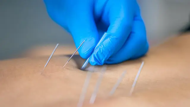 Acupuncture - Level 3 Advanced Diploma